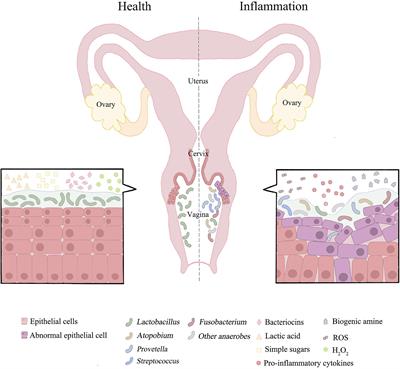 From Microbiome to Inflammation: The Key Drivers of Cervical Cancer